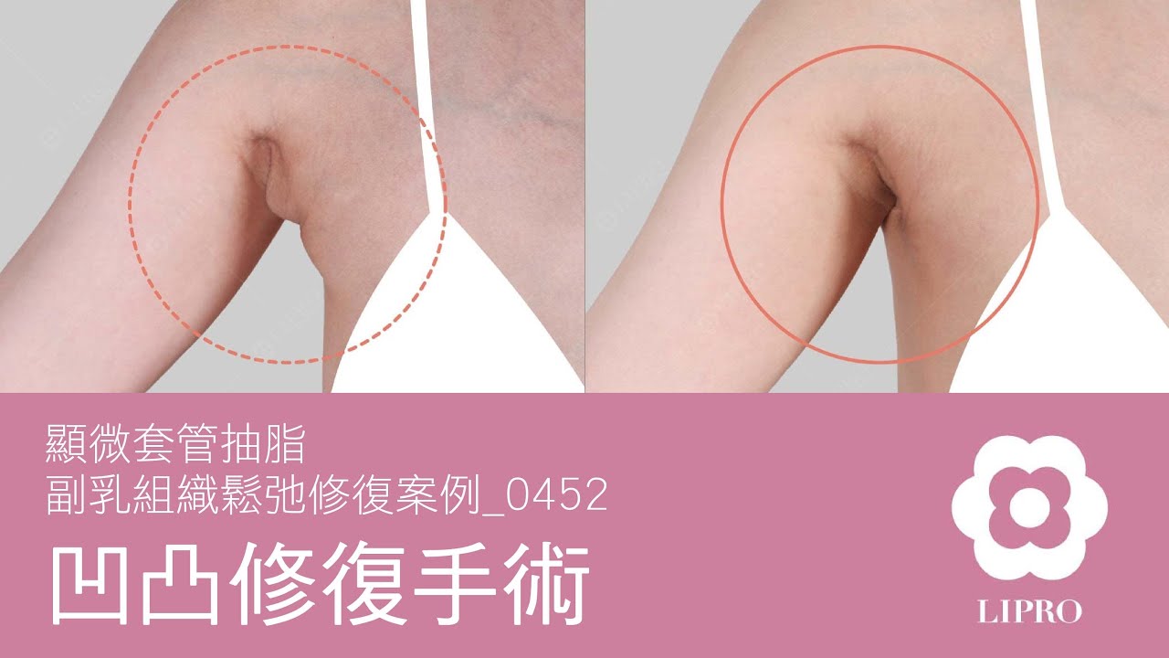 凹凸修復手術｜顯微套管抽脂｜副乳組織鬆弛修復案例_0452