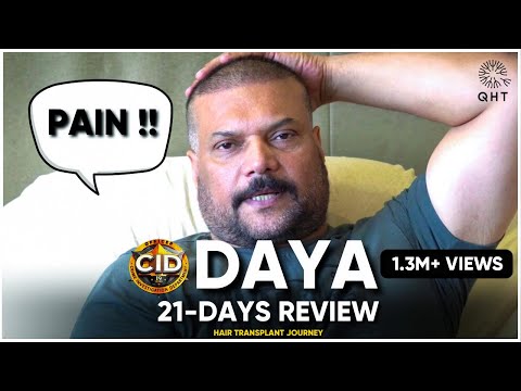 FUE Hair Transplant Results | DAYA's FUE Hair Transplant Results - Actor's Honest Experience | Hair