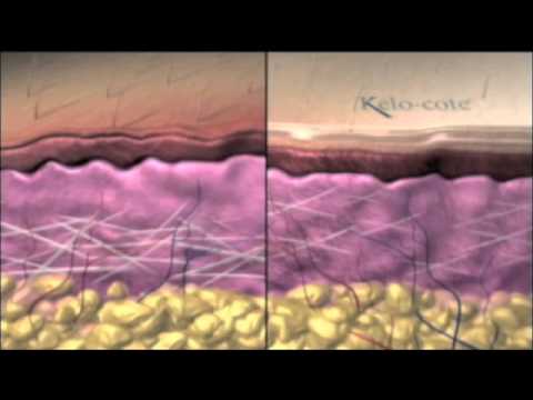 Die Wirkweise von Kelo-Cote (zur Behandlung von Narben)