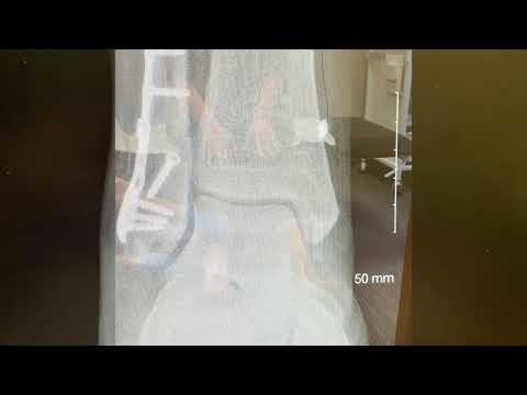 Physiotherapy Recovery Following Ankle Fracture Surgery. Trimaleolar ankle fracture ORIF