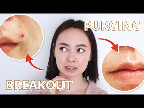 Breakout vs. Purging – I’ve Had Both (With Pictures)