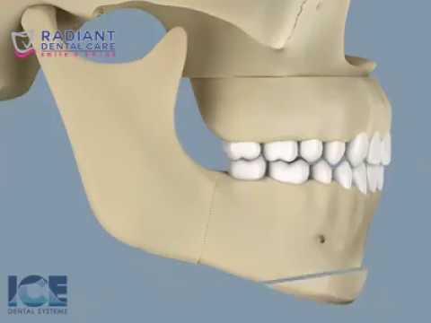 Surgical Correction of Open Bite