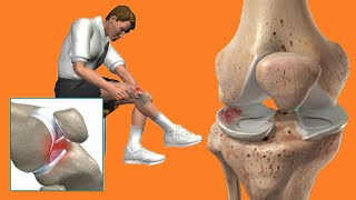 Locked Knee: Causes And Treatment