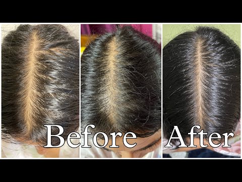 My Honest Hair loss Journey & How I fixed it