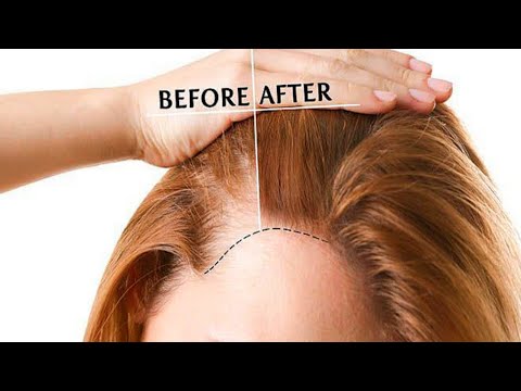 Hair fall: Cure “Baldness” Grow Hair Long & Fast (Men & Women) Video