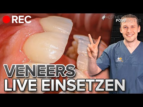 Veneers einsetzen LIVE - Wir zeigen die ganze Transformation im Oberkiefer!