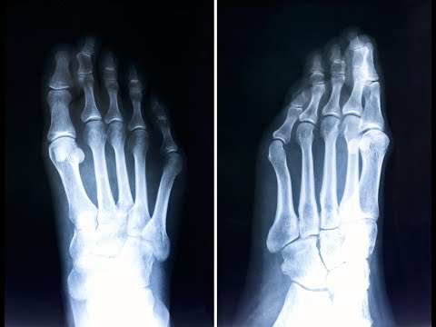 Quotidiano osteocondrosi ricarica Compresse da mal di schiena cronico