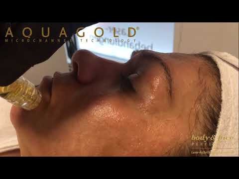 AQUAGOLD® fine touch™ Die Mikroneedeling-Revolution. bodyandface-Perfection Reutlingen