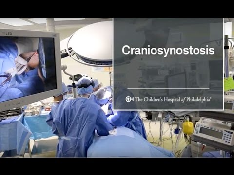 Non-syndromic Craniosynostosis | Children's Hospital of Philadelphia