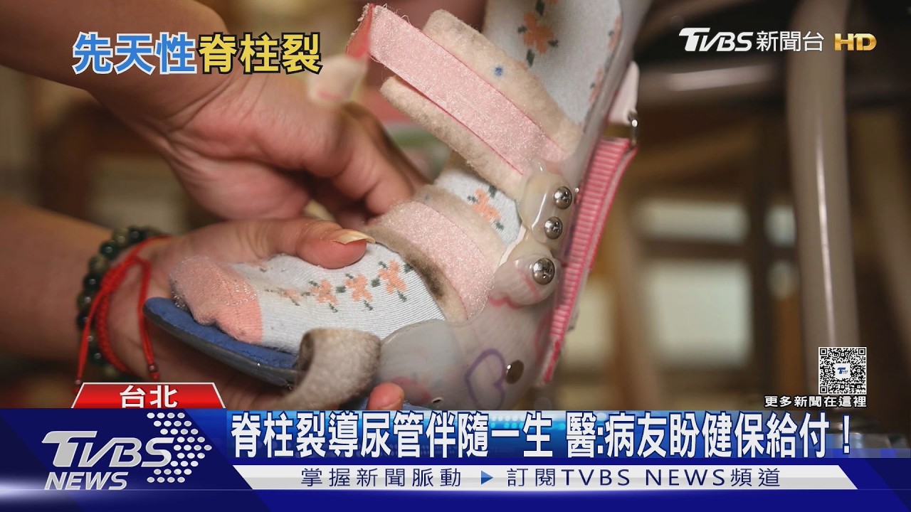 孩子脊椎側彎恐是「這重大疾病」！醫師示警：走路不穩、排尿異常是警訊