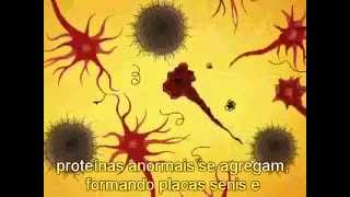 Alzheimer - Como surge a doença