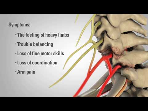 Cervical Laminectomy - Patient Education