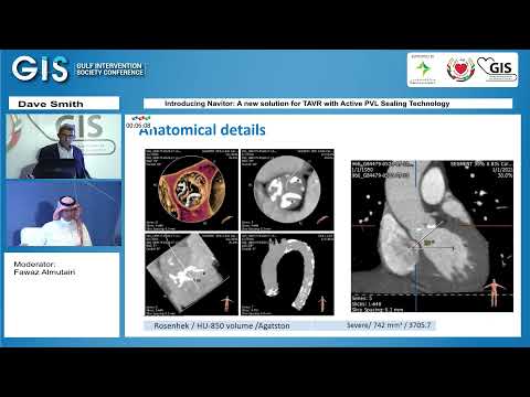 07  Dave Smith   Introducing Navitor  A new solution for TAVR with Active PVL Sealing Technology