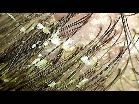 Tuja bei der Schuppenflechte Video von der Schuppenflechte
