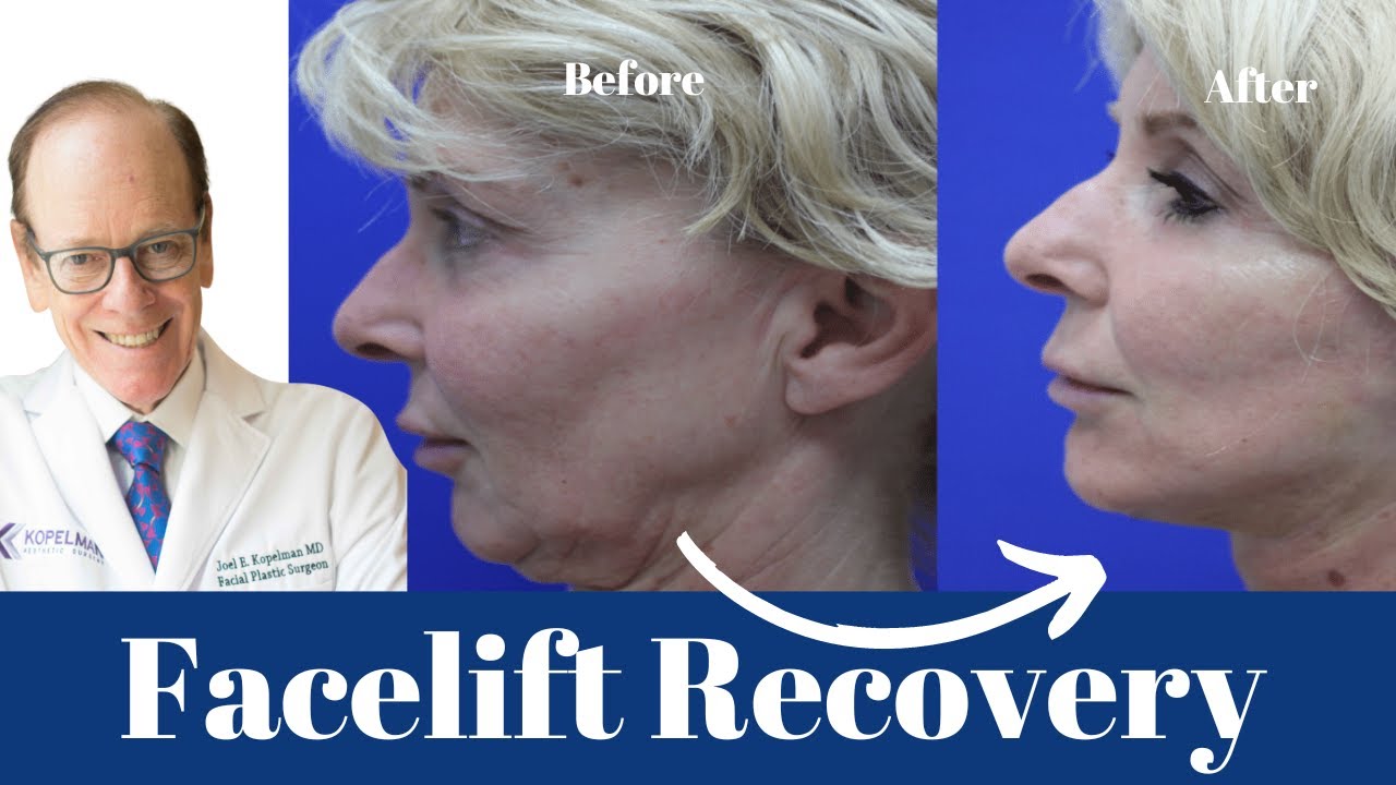 Facelift Recovery: A Comprehensive Guide | Dr. Joel Kopelman