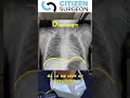 How Do I Read A Chest Xray It S The ABCs