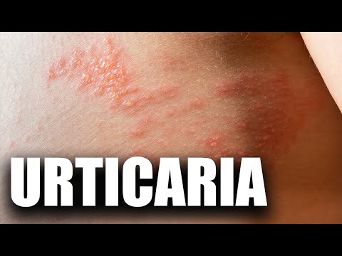 Urticaria — cauze și tratament