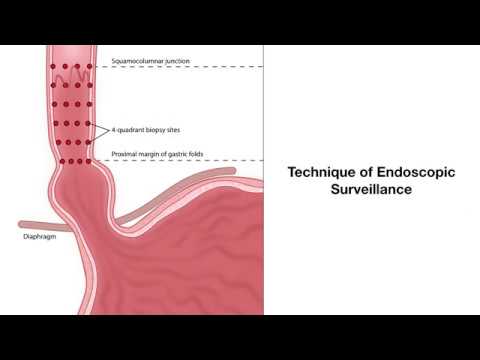 Le diagnostic de l'œsophage de Barrett -biopsie oesophagienne- animation