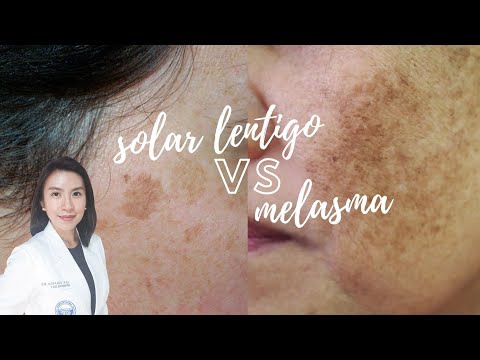 What's the difference: Solar Lentigo vs Melasma?