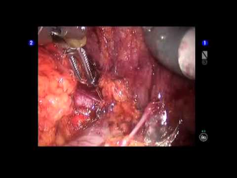 Right Robotic Adrenalectomy