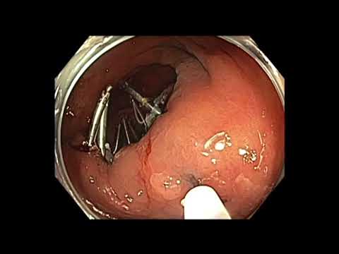 Colonoscopia - colon ascendente - RME - resección de dos lesiones