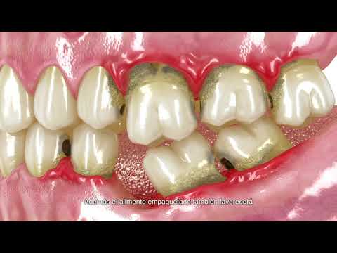 DentTV presenta: La prótesis dental removible