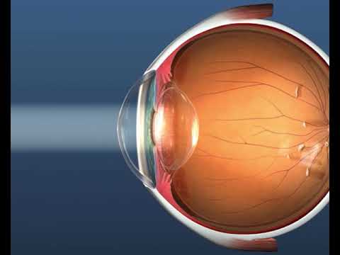 Moscas volantes.. “teias de aranha” ou “manchas” que mudam de posição com os movimentos oculares?