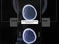 Acute Subdural Hematoma Evacuation Meded Surgeon Neurosurgery Hospital OR Hematoma Acute