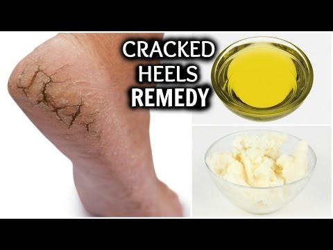 CRACKED HEELS HOME REMEDY │REMOVE DRY HEELS AT HOME FAST AND EASILY │HOW TO GET RID OF CRACKED FEET Video