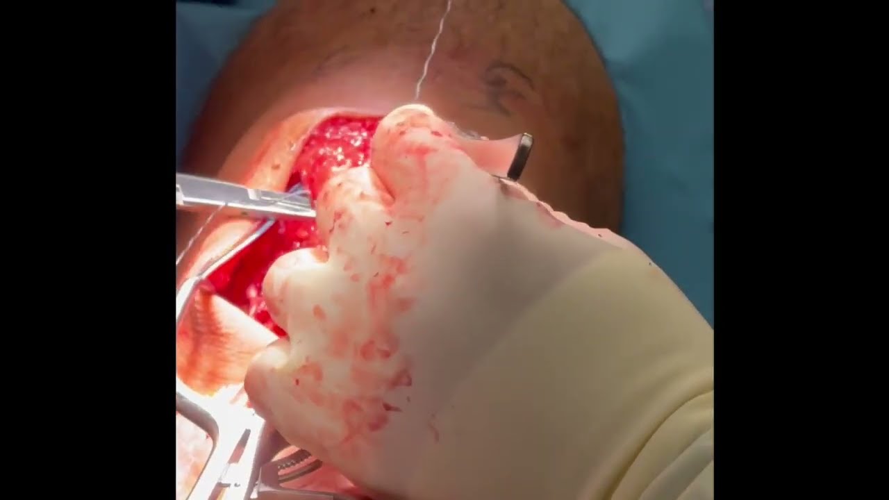 Midsubstance Patella Tendon Repair with Hamstring Augmentation