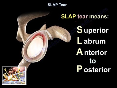 SLAP Tear - Everything You Need To Know - Dr. Nabil Ebraheim