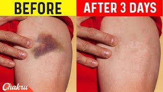 Bruises: 12 Effective Home Remedies to Heal It Quickly
