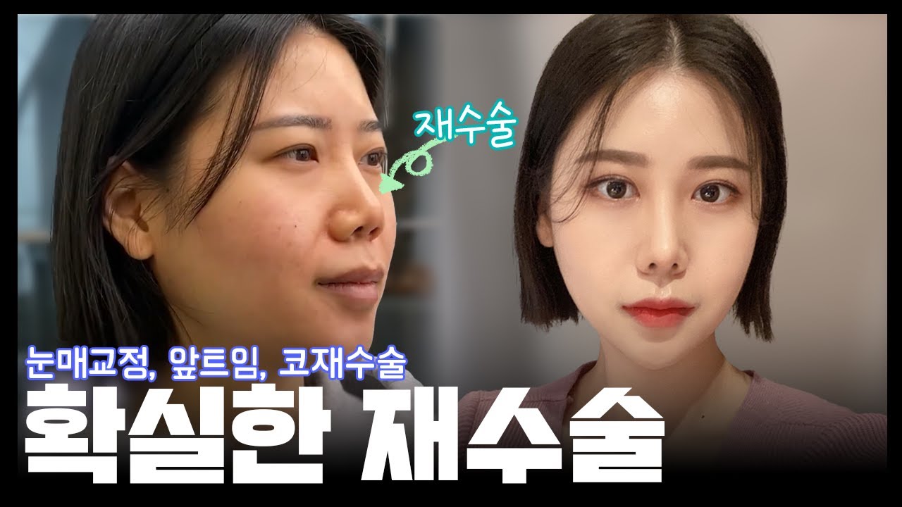 [코재수술후기] 확실한 코재수술 후기? 눈매교정, 앞트임까지