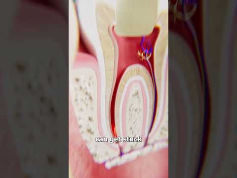 When Root Canal Tools Break Off 😨