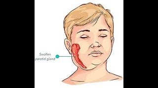 Beke (Mumps), Maga ang Mukha - ni Doc Liza Ramoso-Ong #217