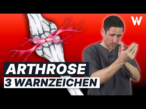 Arthrose feststellen: Die ersten WARNZEICHEN, dass Du betroffen bist!
