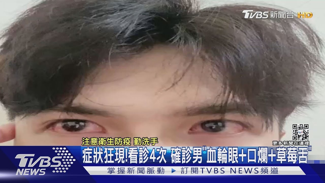 症狀狂現! 看診4次 確診男「血輪眼、口爛、草莓舌」