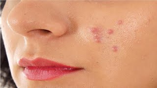 why does acne keeps coming back