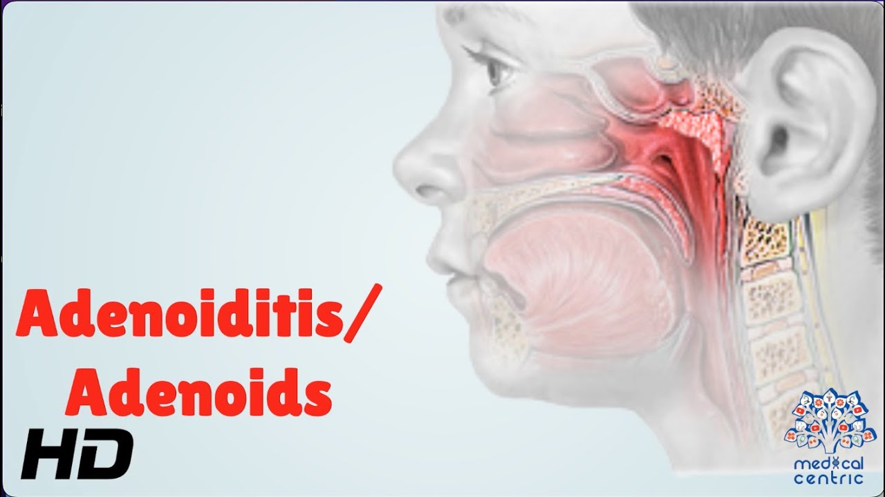 What are the symptoms of adenoid problems in adults? Tipseri