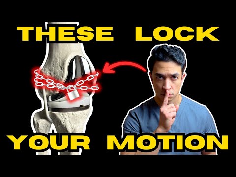 9 Silent Causes of Stiff Knee Replacements