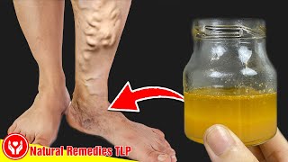 Apply This Mixture On Legs And Get Rid Of Varicose Veins Fast