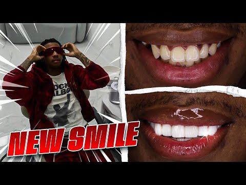 I GOT MY TEETH DONE IN COLUMBIA! BEST VENEERS EVER