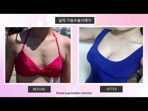 Kasukasuan matapos kanser sa suso surgery Silicone earbuds para sa breast push-up