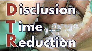 Can Occlusal Adjustment Cure TMD? 'DTR' and T-Scan Experience - PDP255