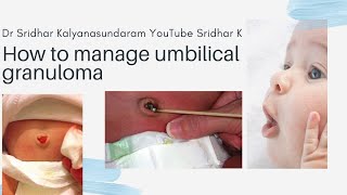 What is an umbilical granuloma? How do we manage t