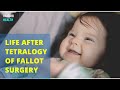 Life After Tetralogy Of Fallot Surgery