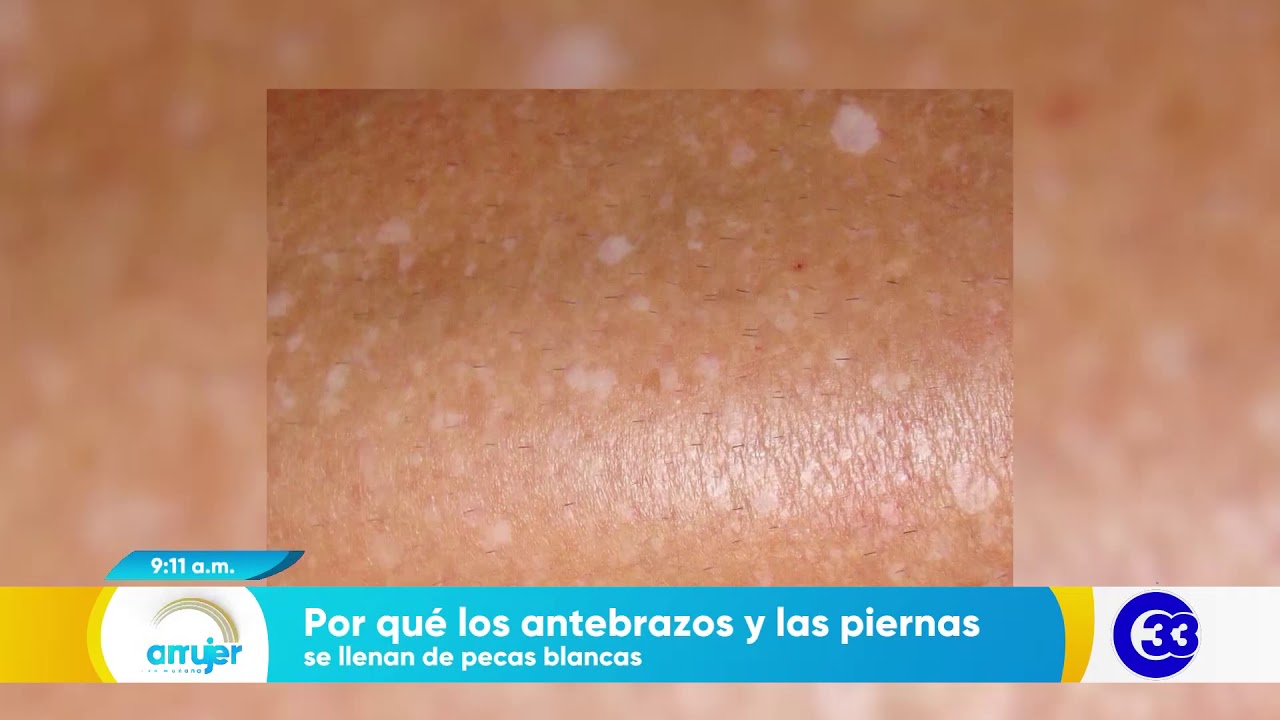 #DeMujerAMujer | Por qué los antebrazos y las piernas se llenan de pecas blancas.