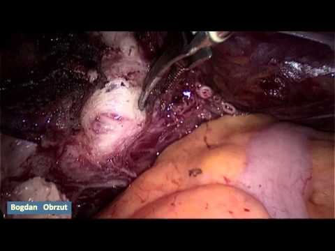 Całkowita histerektomia laparoskopowa