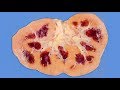 A Boy Ate 25 Laxative Brownies In 1 Hour This Is What Happened To His Kidneys