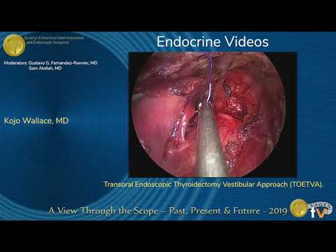 Tiroidectomía transoral endoscópica por abordaje vestibular (TOETVA)